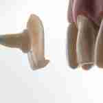 screw-less dental implants, dental implant alternatives