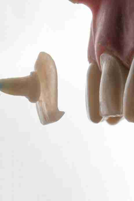 screw-less dental implants, dental implant alternatives