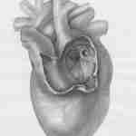 leaky heart valve, valve regurgitation